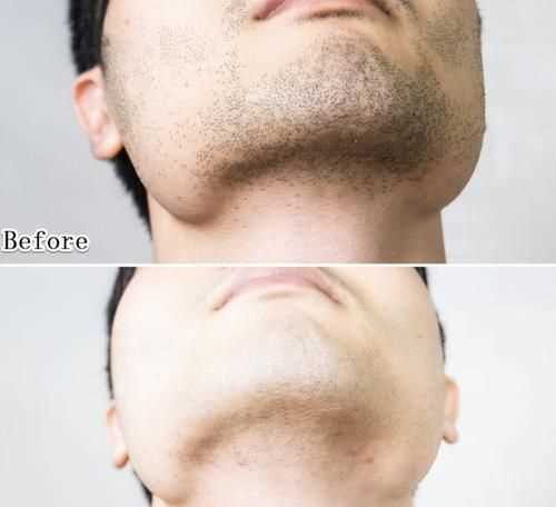 青春期的男生長(zhǎng)胡子是刮還是剪為好