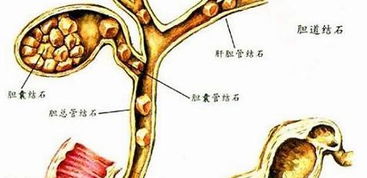 膽石癥有哪些治療方法