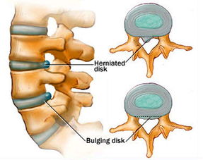 哪些方法可以治療腰間盤(pán)突出