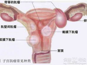 常見(jiàn)的治療子宮肌瘤有哪些方法
