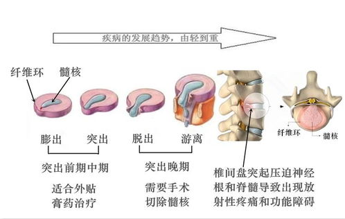 吊線(xiàn)風(fēng)的治療方法有哪些