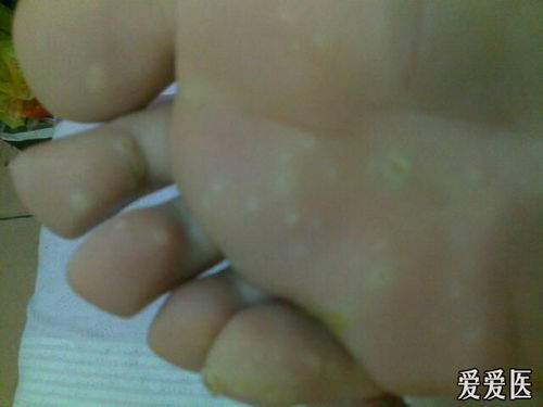 治療疣哪些方法好6