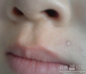 點(diǎn)痣后怎么修復最好方法有哪些