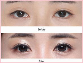 雙眼皮修復手術(shù)方法有哪些方法