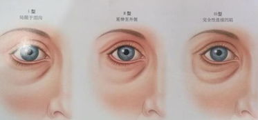 手術(shù)后,注意事項,眼睛