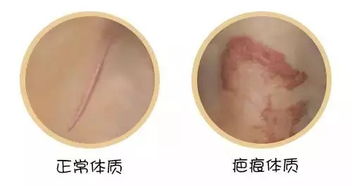 注意事項,去疤