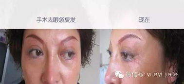 光波,離子,注意事項,去眼袋