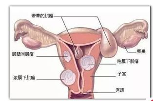 子宮肌瘤懷孕后注意事項