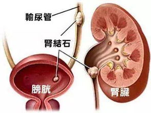 患有腎結石需注意事項