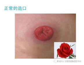 十二指腸穿孔術(shù)后注意事項,腸穿孔術(shù)后的注意事項,腸穿孔造瘺術(shù)后注意事項多久恢復