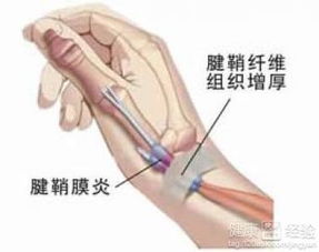 大拇指腱鞘炎要注意什么,大拇指腱鞘炎術(shù)后注意事項(xiàng),大拇指腱鞘炎小針刀術(shù)后注意事項(xiàng)