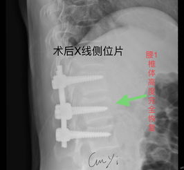 腰椎骨折手術(shù)術(shù)中注意事項