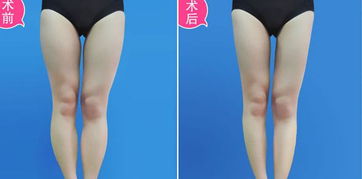 大腿吸脂后應注意事項
