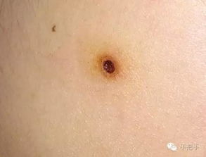電離子點(diǎn)痣后注意事項,點(diǎn)痣注意事項點(diǎn)痣忌口,點(diǎn)痣后注意事項