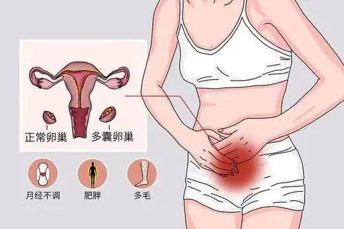 多囊孕期注意事項