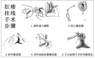 肛瘺,術(shù)前,注意事項(xiàng)