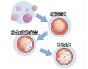 取宮頸hpv標本注意事項