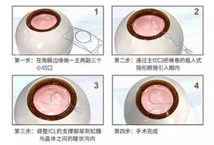 做高度近視手術(shù)術(shù)前注意事項