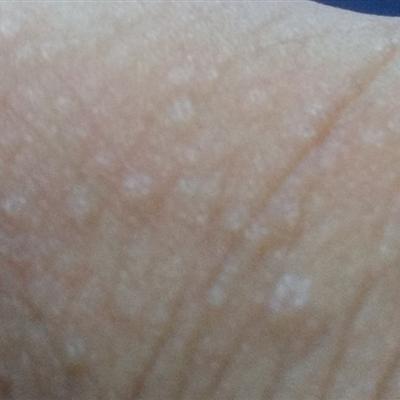 病毒疣尤治療注意事項