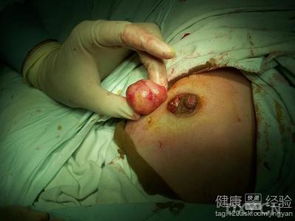 乳腺纖維瘤拆線后注意事項,乳腺纖維瘤切除術(shù)后注意事項,乳腺纖維瘤手術(shù)后注意事項及飲食