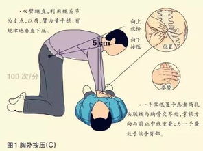 簡(jiǎn)述胸外按壓注意事項