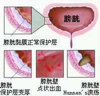 膀胱炎術(shù)后飲食注意事項