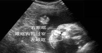 孕婦胎兒畸形幾個(gè)月引產(chǎn)注意事項