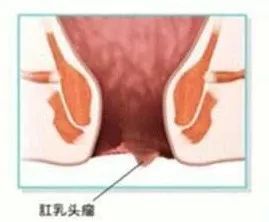 肛乳頭肥大結扎術(shù)后注意事項