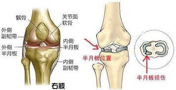 小孩膝蓋半月板損傷注意事項