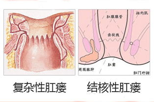 內瘺的術(shù)后護理及注意事項,動(dòng)靜脈內瘺的護理與注意事項,肛瘺術(shù)后護理注意事項