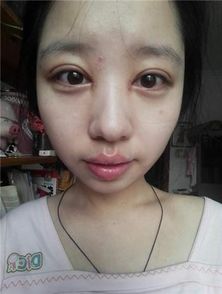 全切雙眼皮第一天注意事項(xiàng)