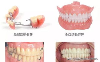 活動(dòng)義齒的注意事項,活動(dòng)義齒佩戴注意事項,活動(dòng)義齒的適應癥和禁忌癥