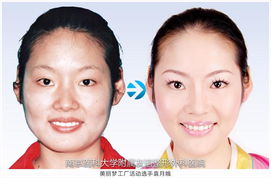 嘴巴整容注意事項