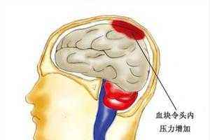 腦出血術(shù)后注意事項