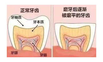 磨牙,注意事項