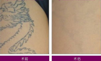 洗紋身術(shù)后注意事項