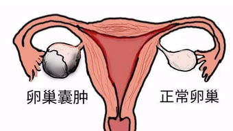 左側卵巢囊腫注意事項