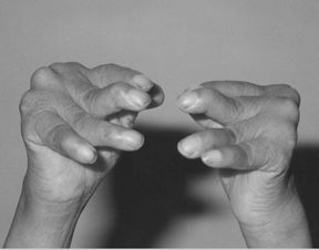 復發(fā)性風(fēng)濕癥注意事項