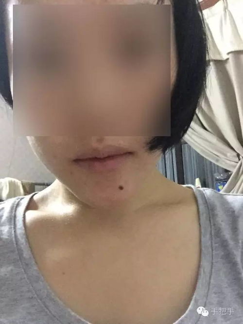 注意事項,電燒法點(diǎn)痣