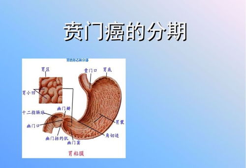 賁門癌手術(shù)體位注意事項(xiàng),賁門癌的飲食注意事項(xiàng),賁門癌術(shù)前注意事項(xiàng)