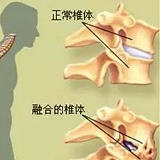 關(guān)節炎,脊柱,注意事項