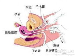 引產(chǎn)后有什么注意事項嗎,引產(chǎn)前有什么注意事項,引產(chǎn)后的注意事項和飲食調理
