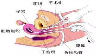 無(wú)痛人流流程和注意事項,無(wú)痛人流后注意事項,無(wú)痛人流當天注意事項