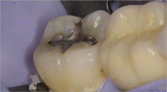 貴金屬補牙后注意事項