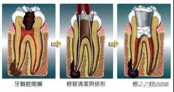根管治療后樹(shù)脂補牙后注意事項