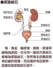 尿路結石術(shù)后注意事項