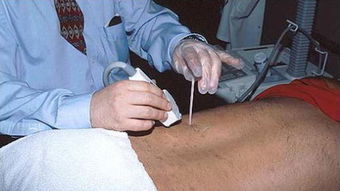 腎穿刺后的注意事項(xiàng),做完腎穿刺的注意事項(xiàng),做過(guò)腎穿刺后注意事項(xiàng)