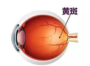 眼睛黃斑水腫注意事項