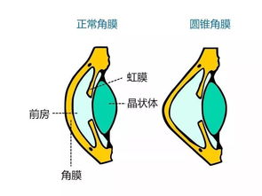 圓錐角膜術(shù)后注意事項,圓錐角膜平時(shí)注意事項,圓錐角膜配鏡注意事項