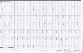 阿托品激發(fā)試驗注意事項,做完阿托品試驗注意事項,阿托品的使用方法和注意事項